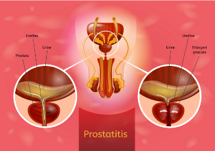 a prostatite