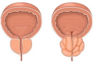 A prostatite