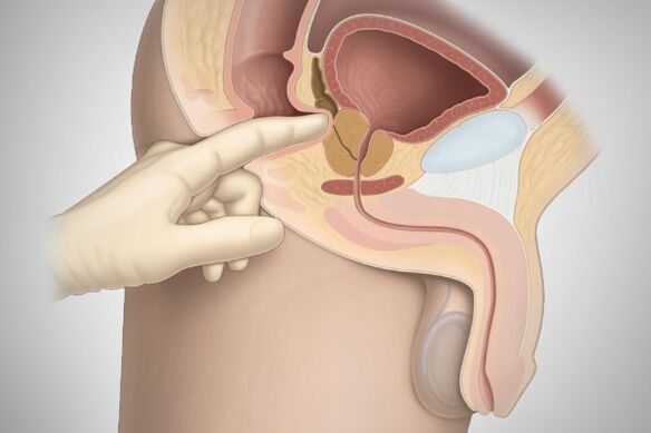 Massagem de próstata para prostatite bacteriana