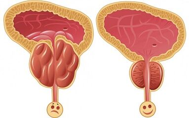 como Prostalix funciona para prostatite antes e depois do tratamento